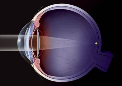 眼科醫(yī)療的新篇章：探索人工晶狀體的最新進(jìn)展