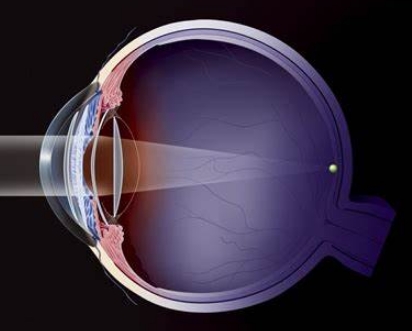 眼科醫(yī)療的未來(lái)：揭秘多焦點(diǎn)人工晶狀體的創(chuàng)新設(shè)計(jì)