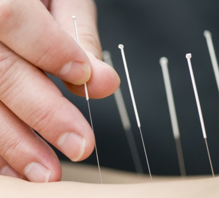 針灸針：傳統(tǒng)中醫(yī)治療用精密制造一次性無菌針灸針套裝