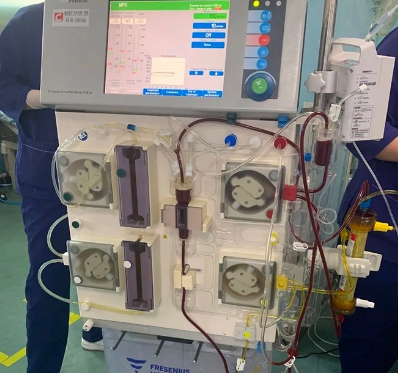 血漿置換機(jī)