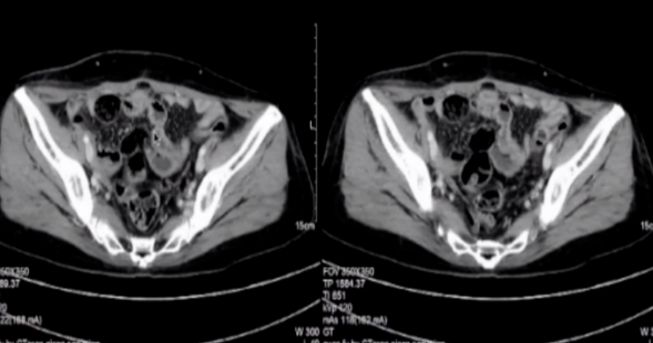 卵巢癌風(fēng)險評估系統(tǒng)?